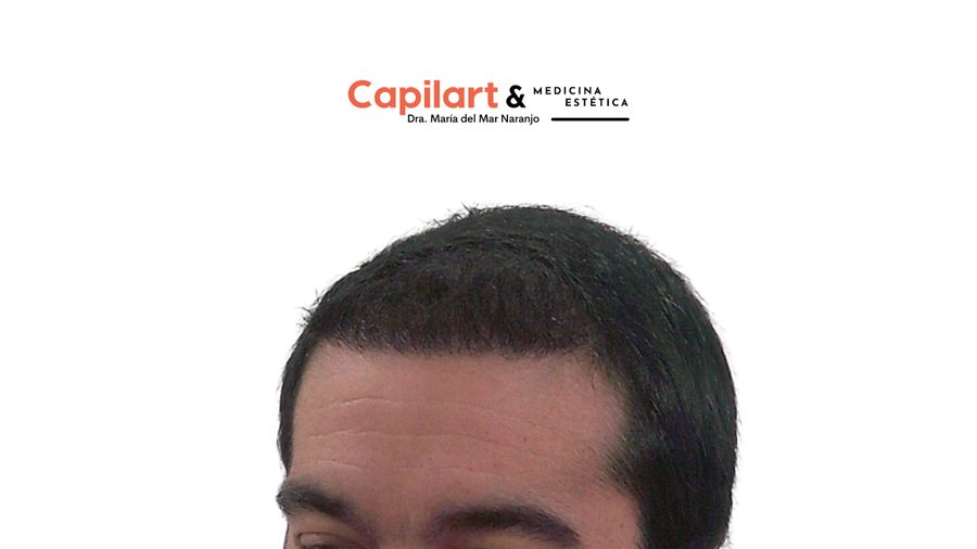 Caso 1: cabello tres meses después de la cirugía capilar