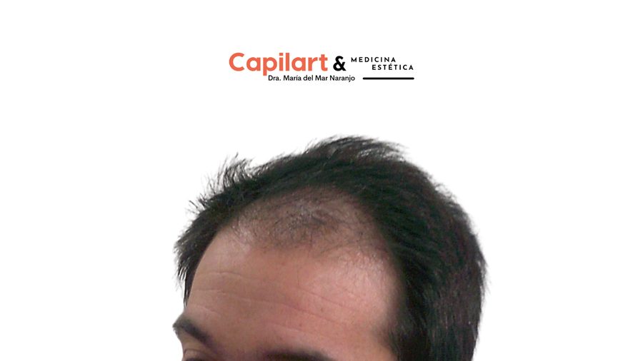 Caso 1: estado del cabello antes de la cirugía capilar