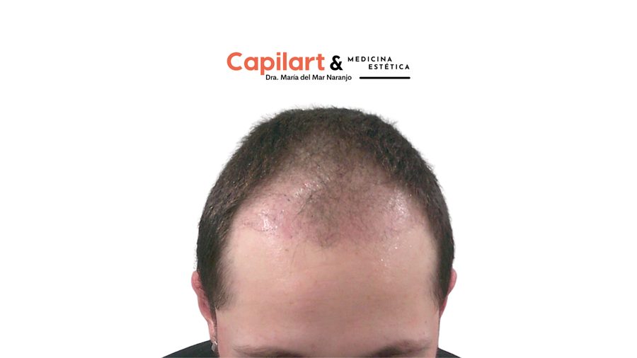 Caso 2: cabello tres meses después de la cirugía capilar