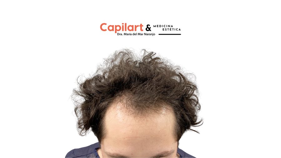 Caso 2: estado del cabello antes de la cirugía capilar