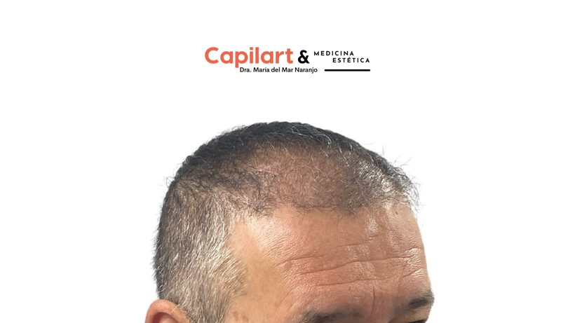 Trabajo del equipo de Capilart en trasplante capilar