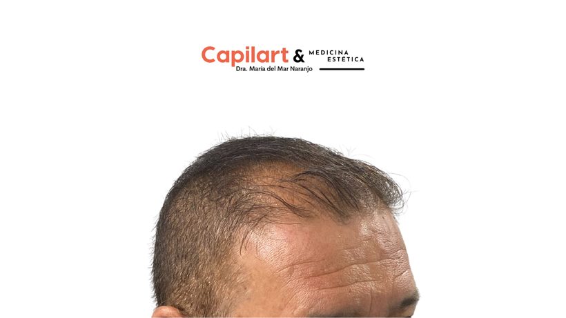 Detalle del trabajo del equipo de Capilart en un injerto capilar