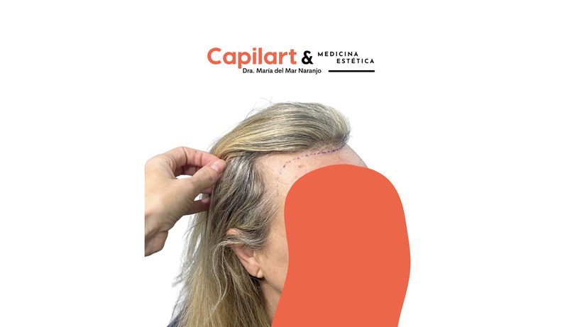 Seguimiento de un tratamiento capilar en la clínica Capilart